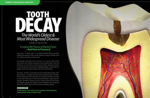 Tooth Decay - Dear Doctor Magazine
