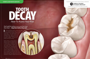 Tooth Decay – Dear Doctor Magazine
