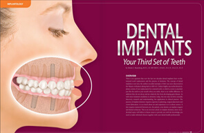 Dental Implants - Dear Doctor Magazine