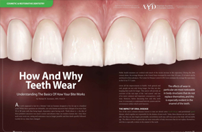 Teeth Wear - Dear Doctor Magazine