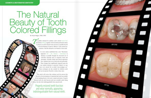 Tooth Colored Fillings - Dear Doctor Magazine